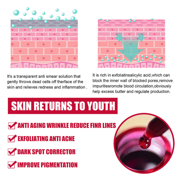 Fruit Acid Salicylic Acid Exfoliation Closed Mouth Blackheads Acne Shrinkage Treatment